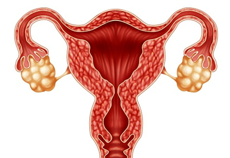Hội chứng buồng trứng đa nang có thể gặp ở nhiều độ tuổi