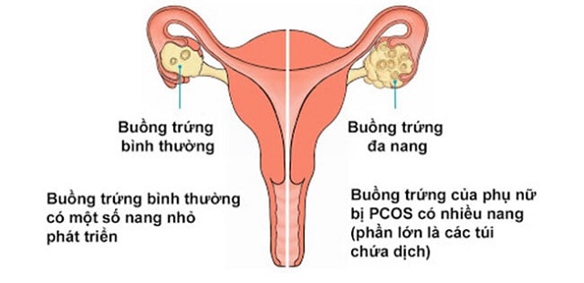 Hình ảnh buồng trứng bình thường và buồng trứng đa nang