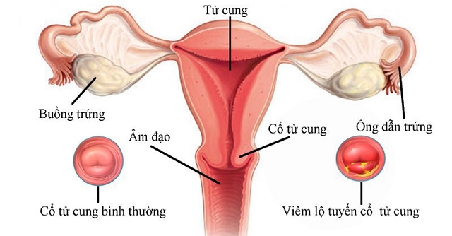 Viêm âm đạo ra mủ dẫn đến viêm lộ tuyến cổ tử cung
