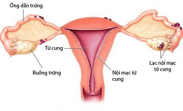 Bị lạc nội mạc tử cung cũng là một trong những nguyên nhân gây vô sinh ở nữ