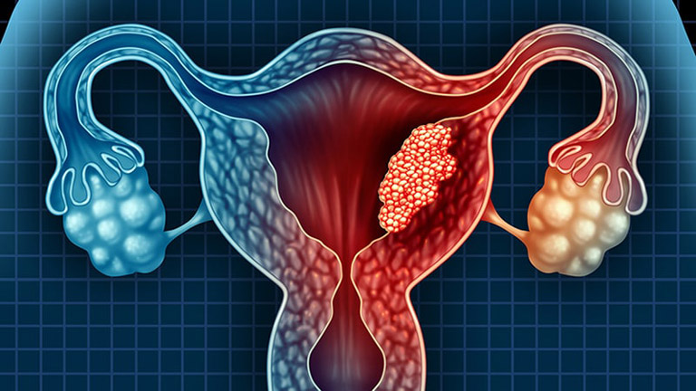 Đa nang buồng trứng - Nguyên nhân gây ung thư nội mạc tử cung
