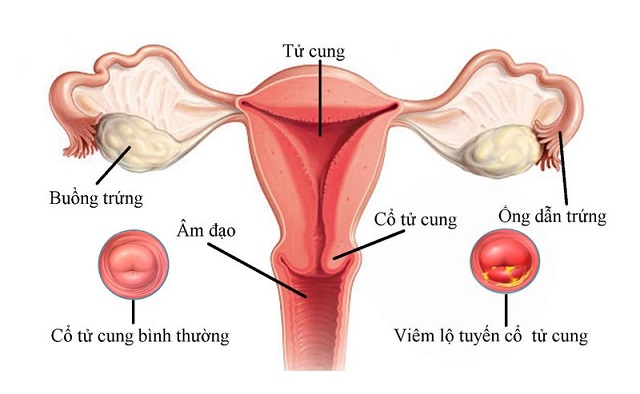 Mắc các bệnh lý ở tử cung có thể gây vô sinh ở nữ giới