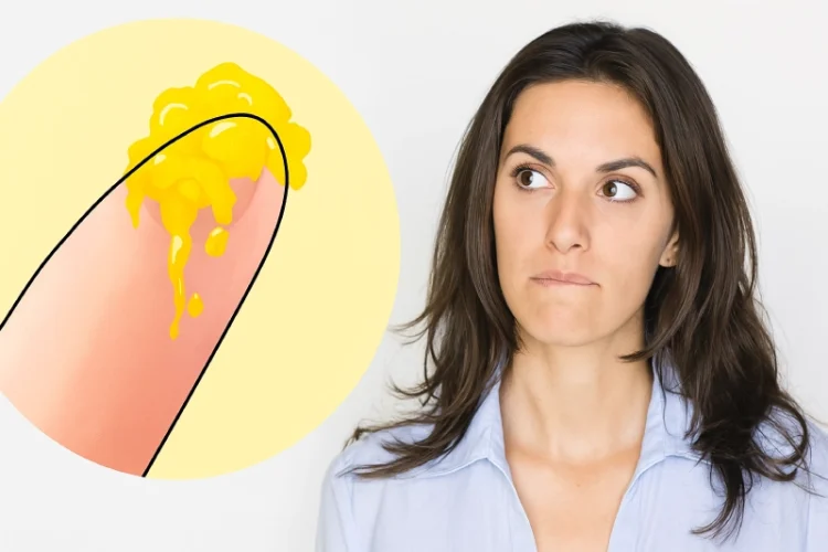 Ra nhiều khí hư vàng