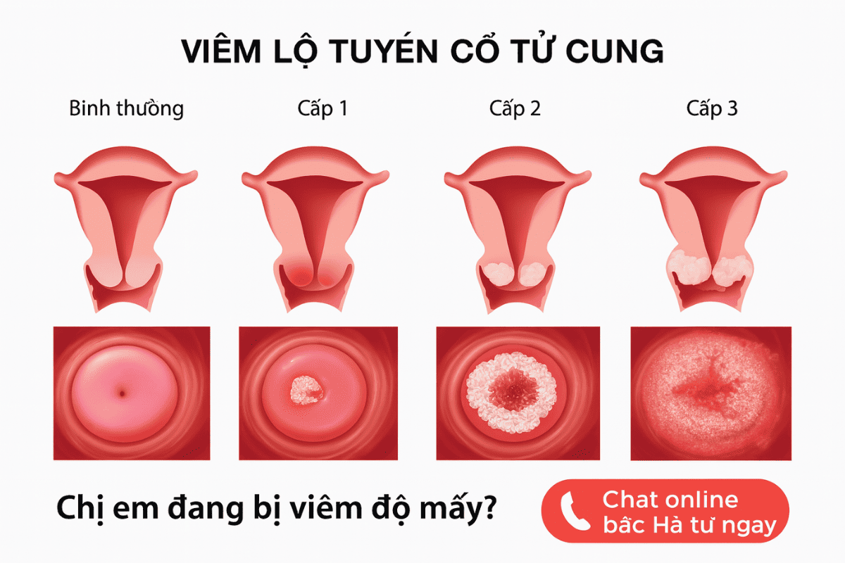 Viêm lộ tuyến cổ tử cung độ mấy