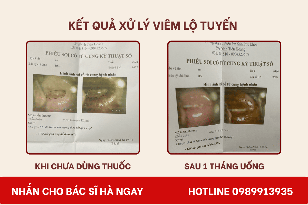Kết quả xử lý viêm lộ tuyến sau 1 tháng