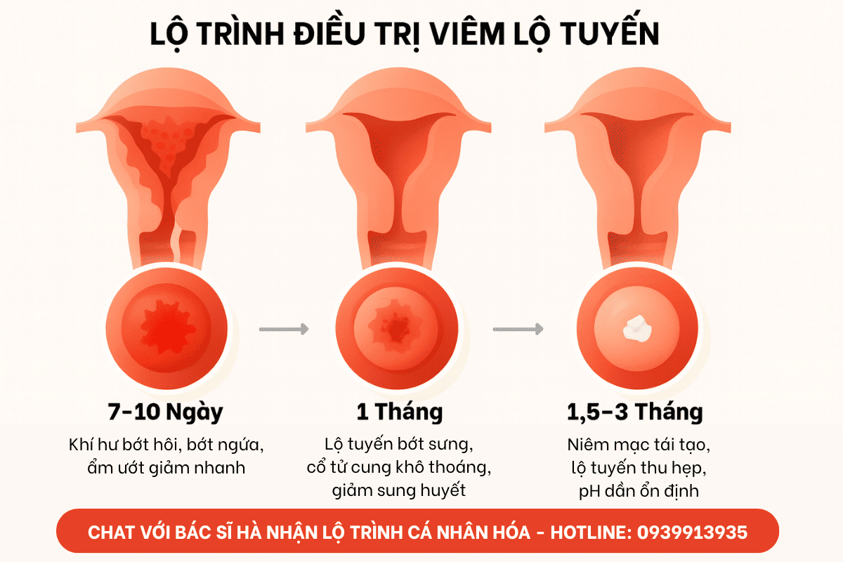 Lộ trình viêm lộ tuyến cá nhân hóa