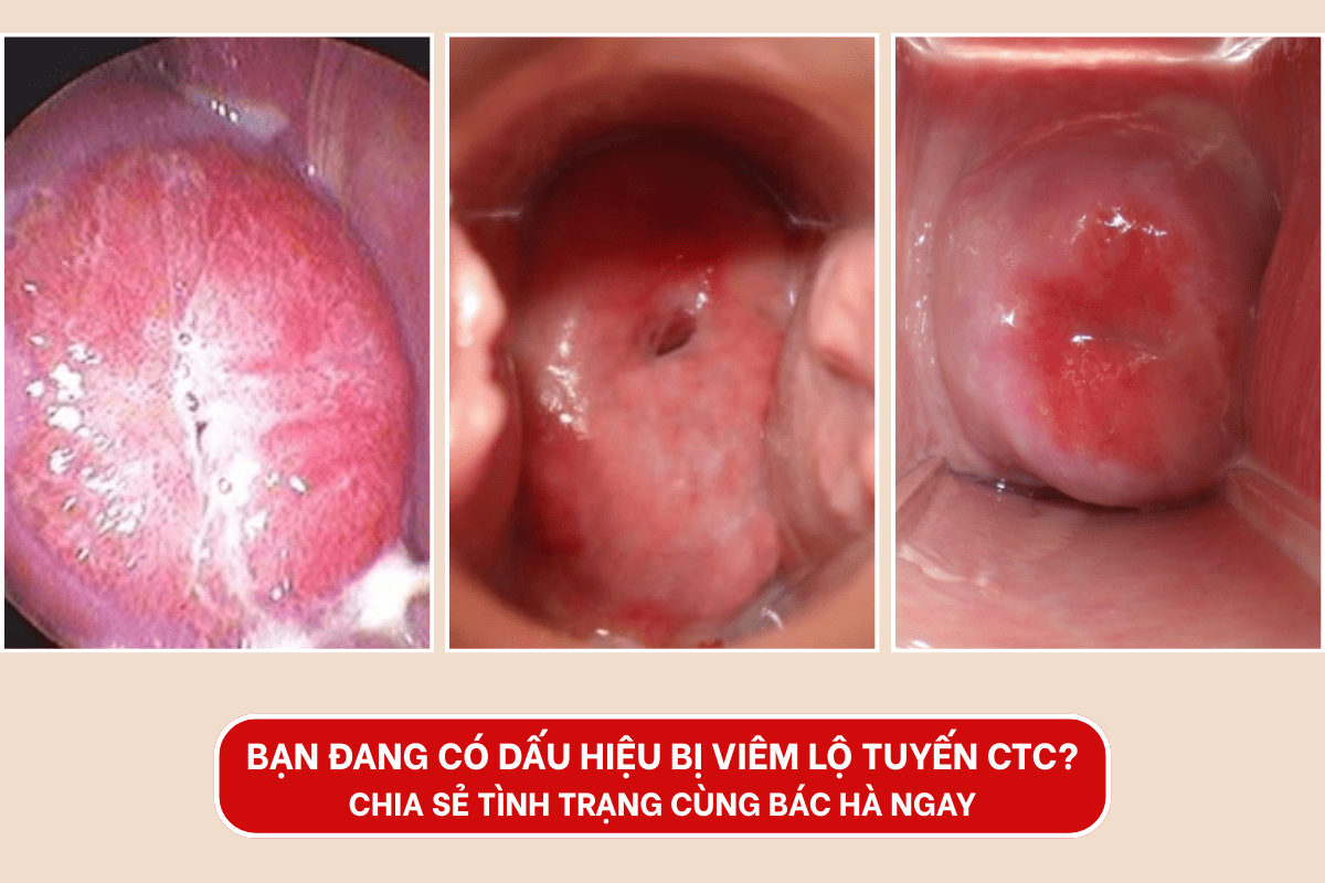 Chia sẻ tình trạng viêm lộ tuyến CTC