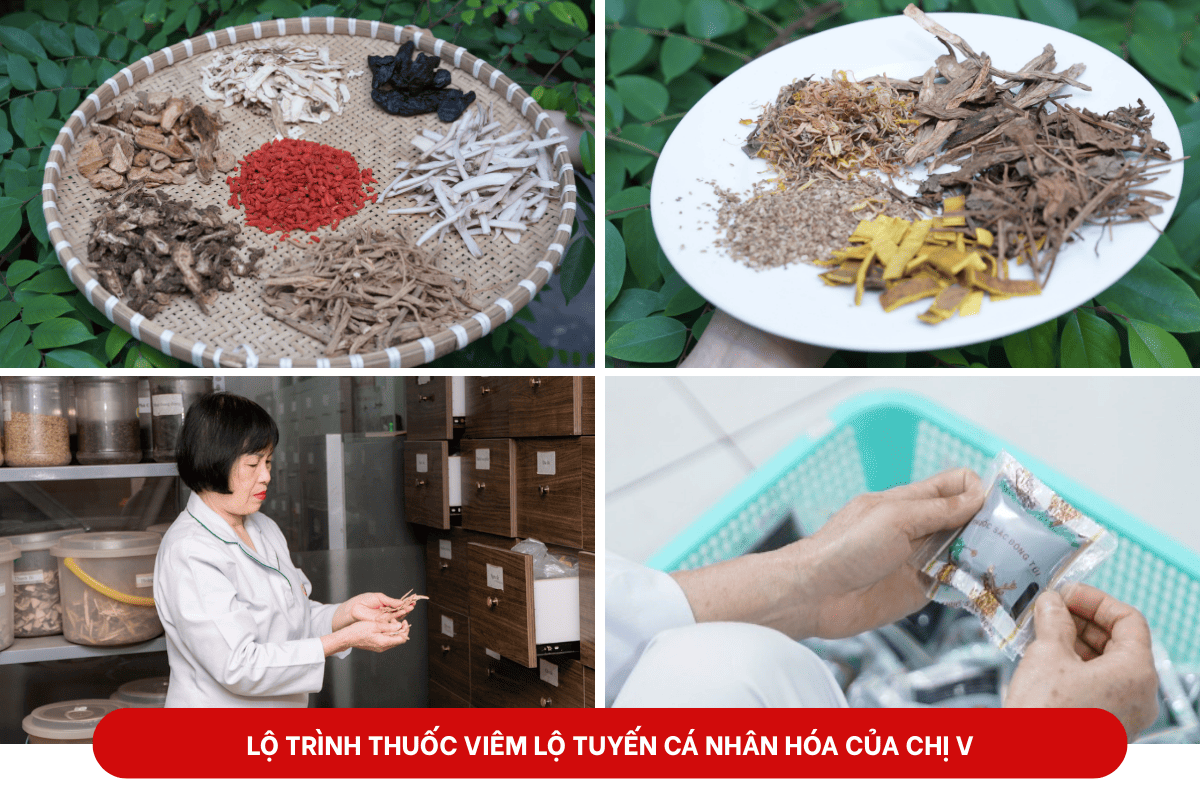 Bài thuốc chữa viêm lộ tuyến cá nhân hóa