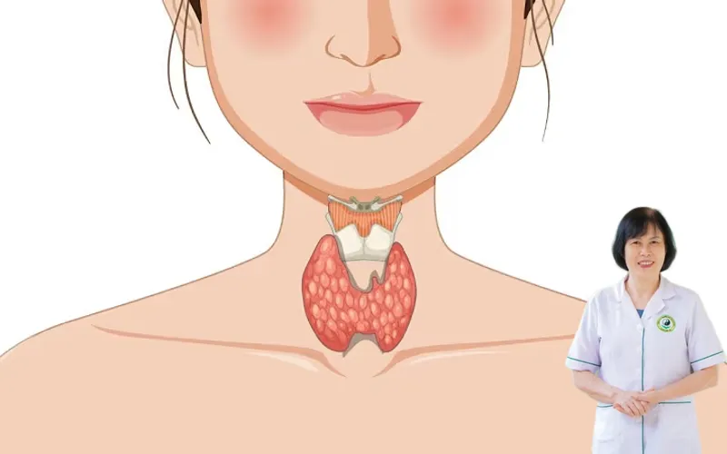 Bệnh basedow c&oacute; g&acirc;y v&ocirc; sinh kh&ocirc;ng
