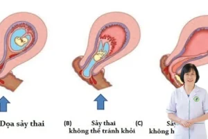Bị sảy thai có gây vô sinh không và liệu pháp Đông y giúp phục hồi tử cung, bảo vệ thiên chức.