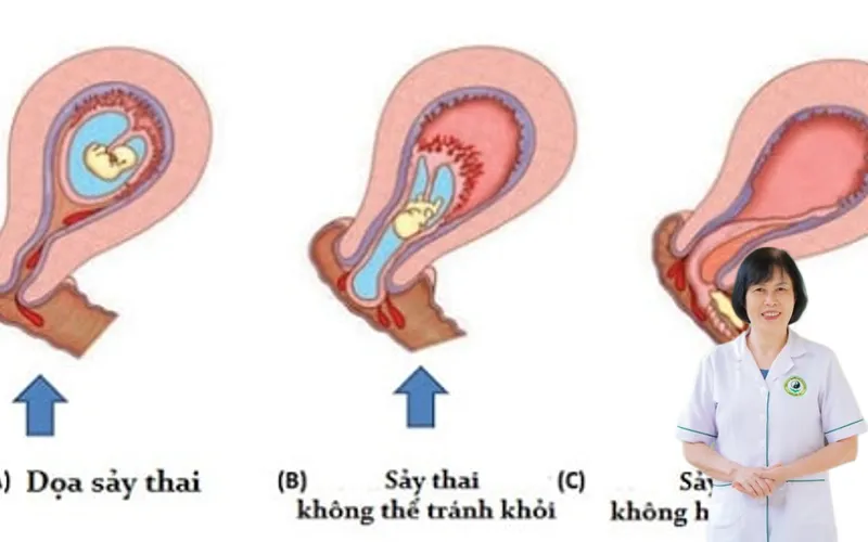 Bị sảy thai có bị vô sinh không