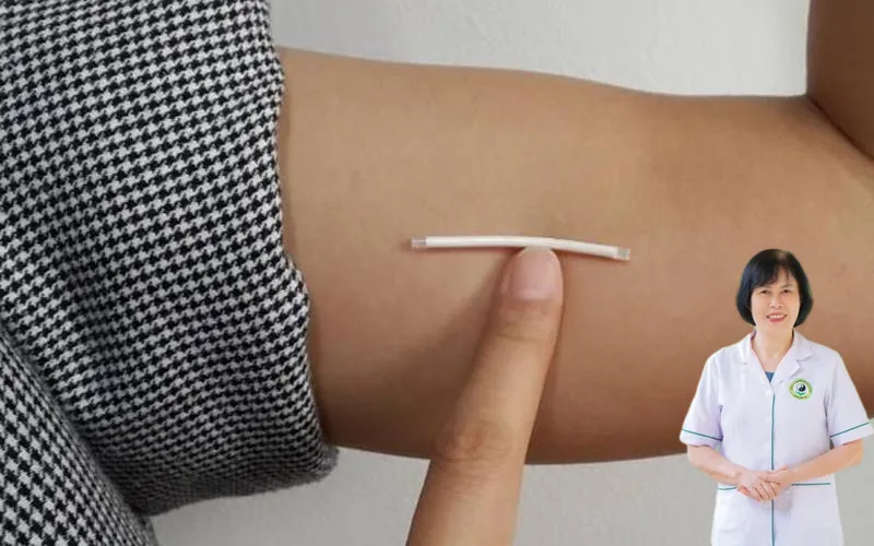 Cấy que tr&aacute;nh thai c&oacute; bị v&ocirc; sinh kh&ocirc;ng
