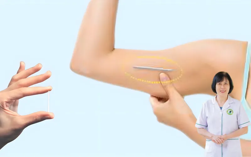 Cấy que tránh thai có gây vô sinh không