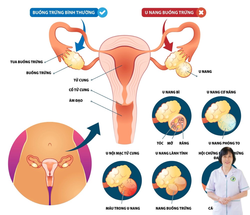 u nang đa thùy đặc buồng trứng u nang đa thùy đặc buồng trứng