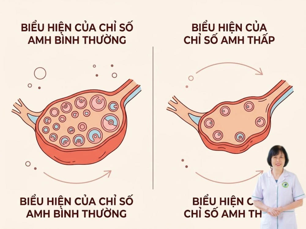 chỉ số amh thấp chỉ số amh thấp